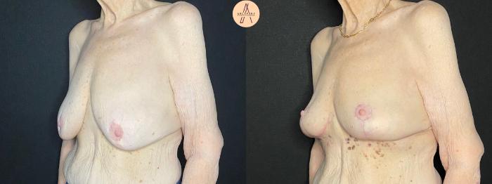Before & After Breast Lift Case 109 Left Oblique View in San Antonio, Texas