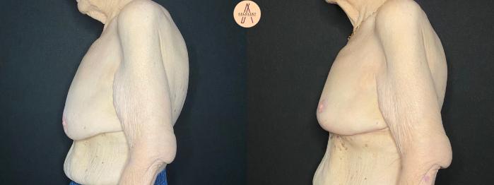 Before & After Breast Lift Case 109 Left Side View in San Antonio, Texas