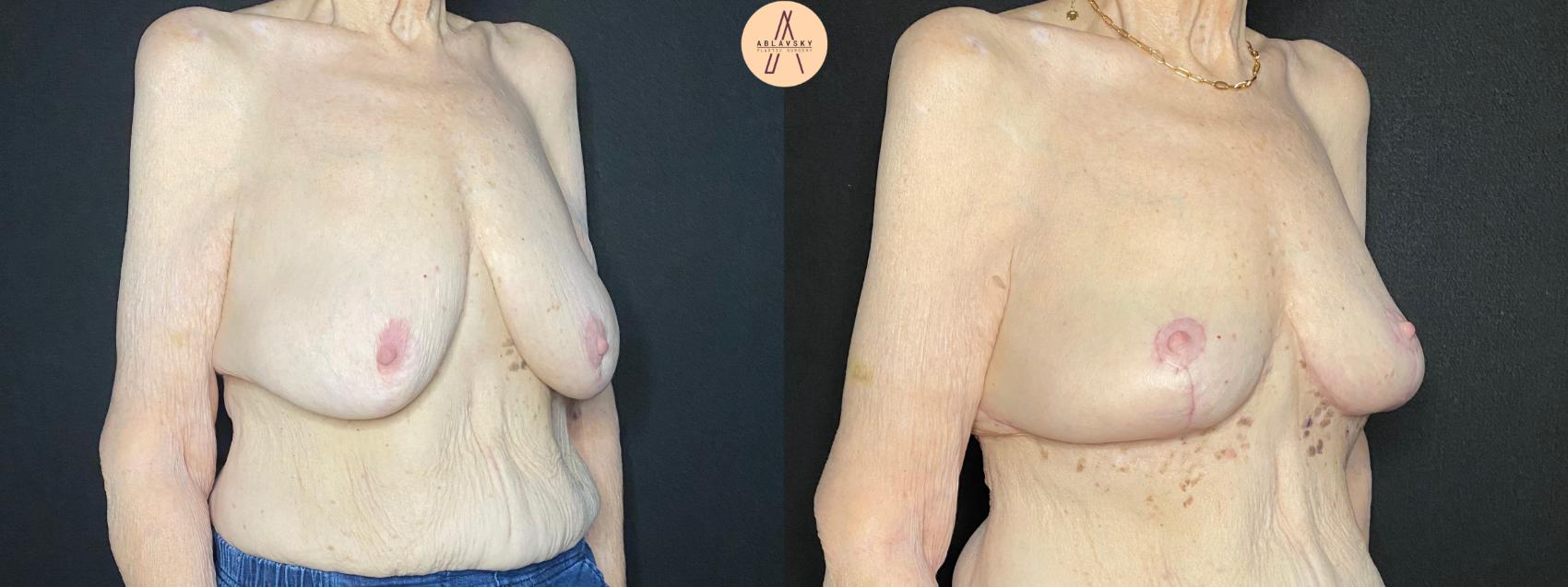 Before & After Breast Lift Case 109 Right Oblique View in San Antonio, Texas