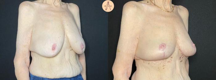 Before & After Breast Lift Case 109 Right Oblique View in San Antonio, Texas