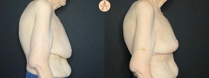 Before & After Breast Lift Case 109 Right Side View in San Antonio, Texas