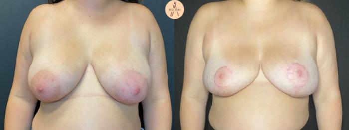 Before & After Breast Reduction Case 115 Front View in San Antonio, Texas