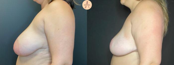 Before & After Breast Reduction Case 115 Left Side View in San Antonio, Texas