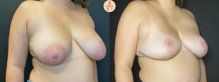 Before & After Breast Reduction Case 115 Right Oblique View in San Antonio, Texas