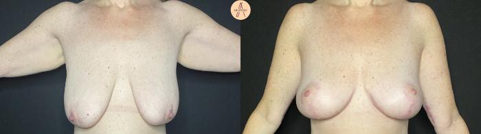 Before & After Breast Lift Case 137 Front View in San Antonio, Texas