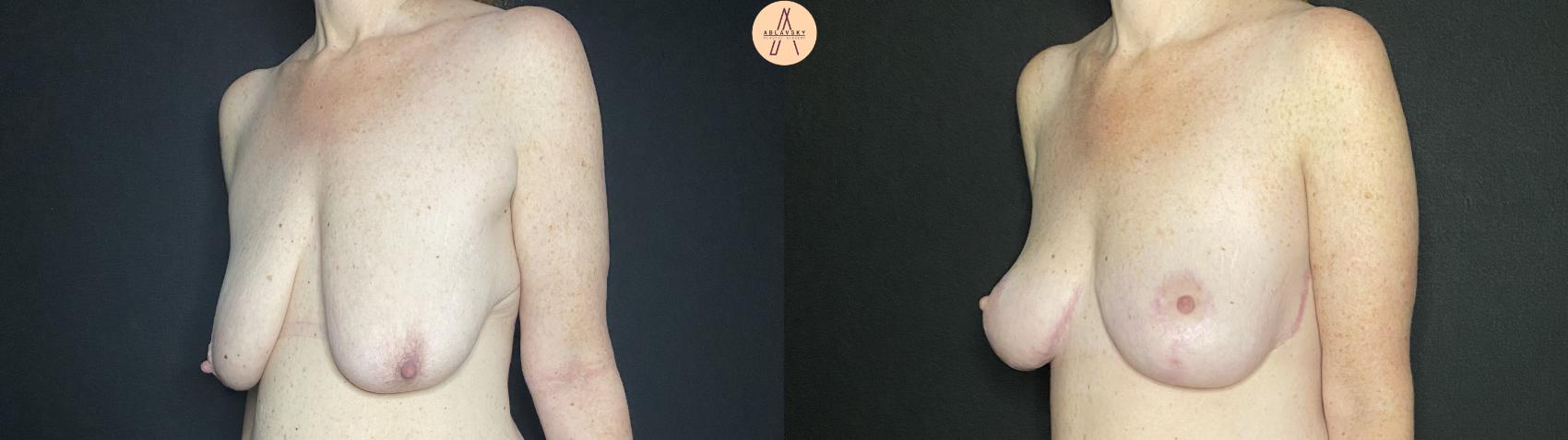 Before & After Breast Lift Case 137 Left Oblique View in San Antonio, Texas