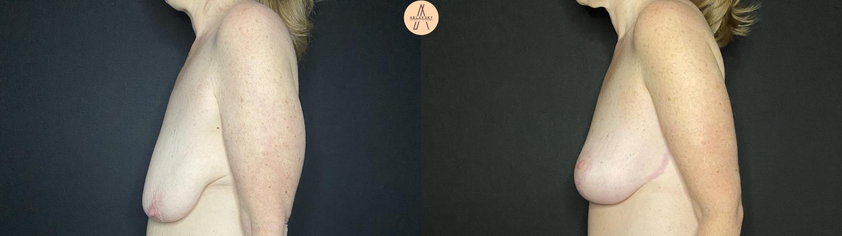 Before & After Breast Lift Case 137 Left Side View in San Antonio, Texas