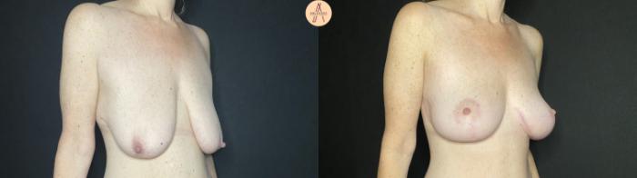 Before & After Breast Lift Case 137 Right Oblique View in San Antonio, Texas