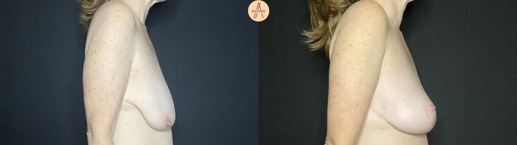 Before & After Breast Lift Case 137 Right Side View in San Antonio, Texas