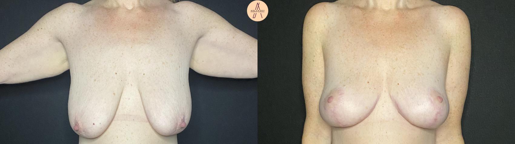 Before & After Breast Lift Case 138 Front View in San Antonio, Texas