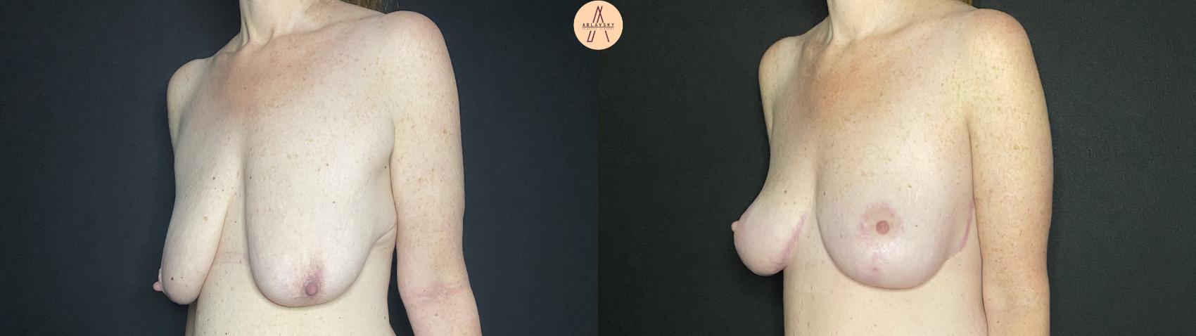Before & After Breast Lift Case 138 Left Oblique View in San Antonio, Texas