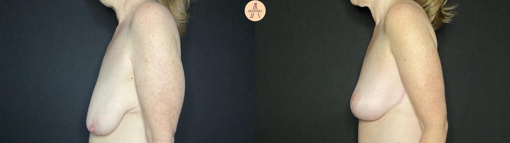 Before & After Breast Lift Case 138 Left Side View in San Antonio, Texas