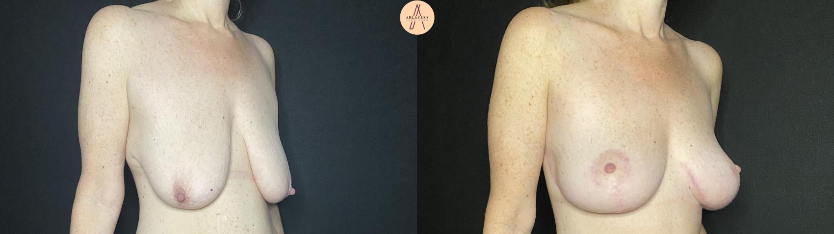 Before & After Breast Lift Case 138 Right Oblique View in San Antonio, Texas