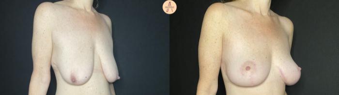 Before & After Breast Lift Case 138 Right Oblique View in San Antonio, Texas