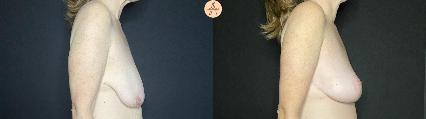 Before & After Breast Lift Case 138 Right Side View in San Antonio, Texas