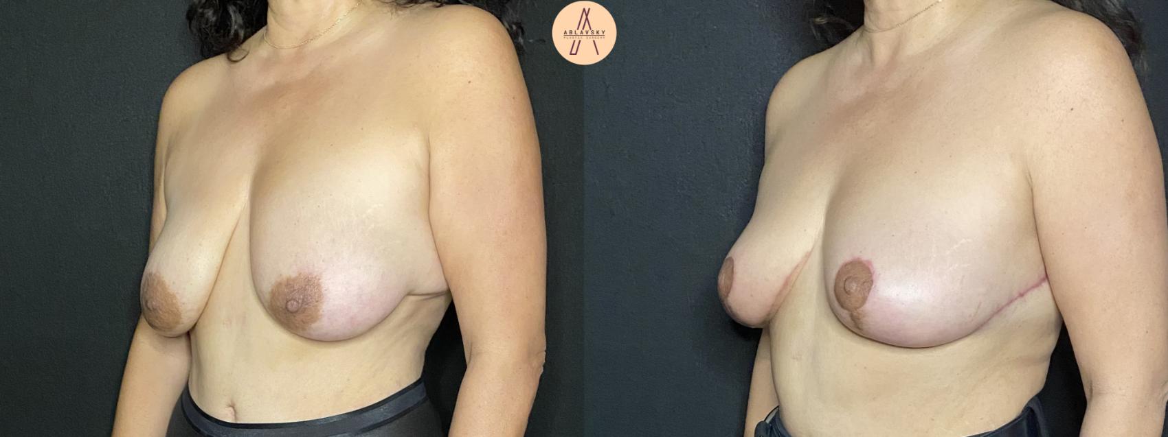 Before & After Breast Lift Case 181 Left Oblique View in San Antonio, Texas