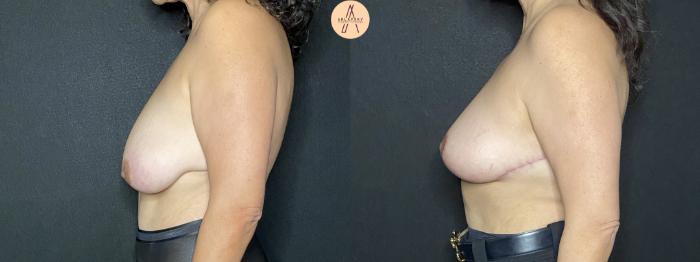 Before & After Breast Lift Case 181 Left Side View in San Antonio, Texas