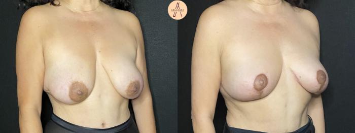 Before & After Breast Lift Case 181 Right Oblique View in San Antonio, Texas