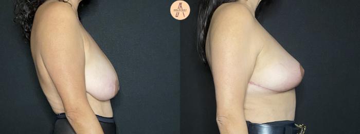 Before & After Breast Lift Case 181 Right Side View in San Antonio, Texas