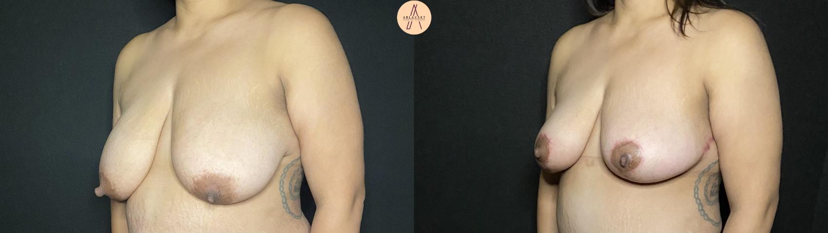 Before & After Breast Lift Case 188 Left Oblique View in San Antonio, Texas