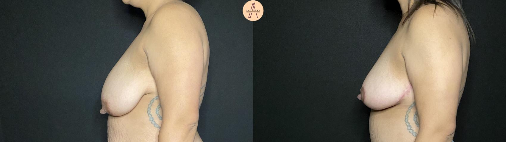 Before & After Breast Lift Case 188 Left Side View in San Antonio, Texas
