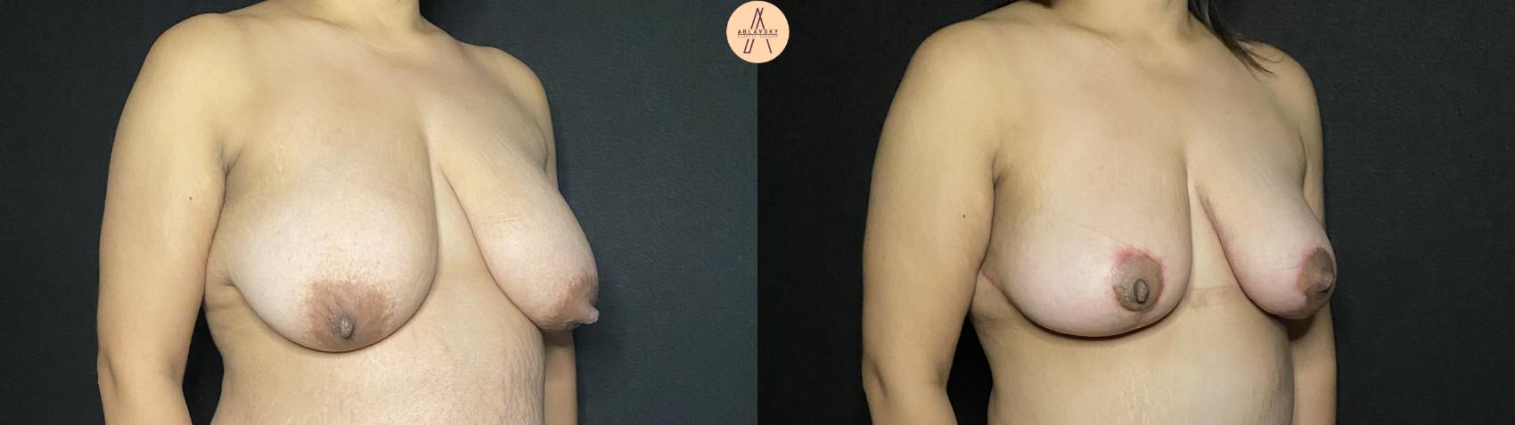 Before & After Breast Lift Case 188 Right Oblique View in San Antonio, Texas