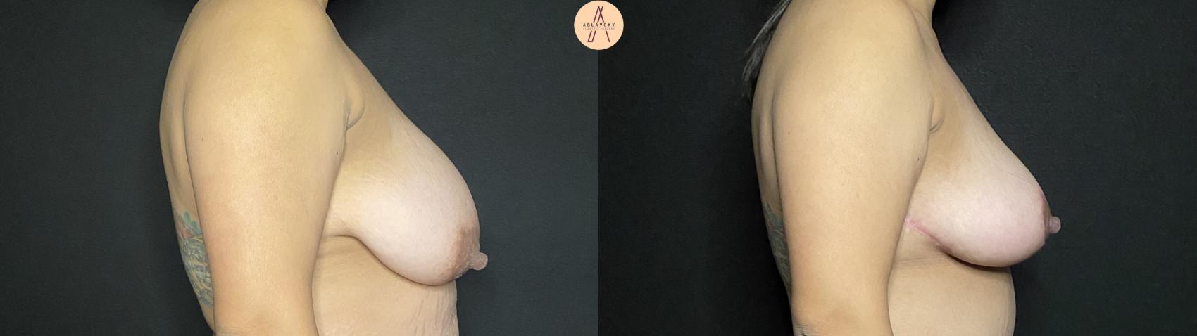Before & After Breast Lift Case 188 Right Side View in San Antonio, Texas