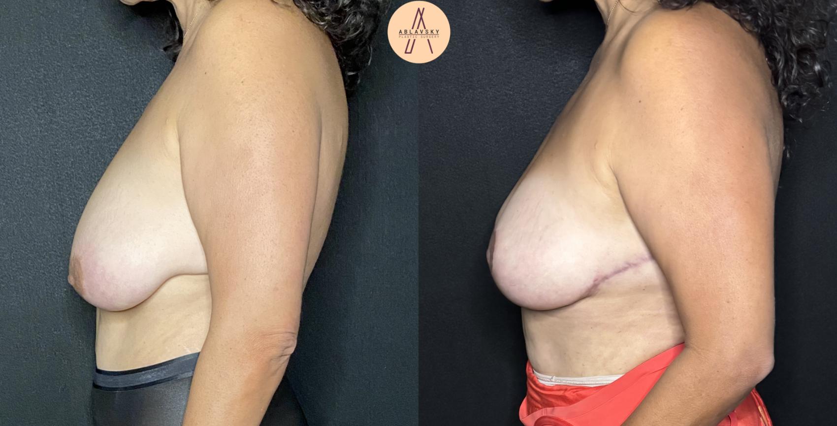 Before & After Breast Lift Case 194 Left Side View in San Antonio, Texas
