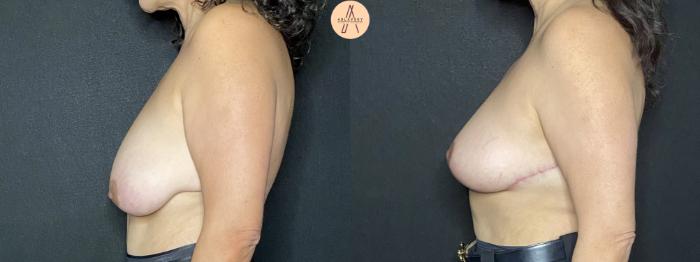 Before & After Breast Lift Case 194 Left Side View in San Antonio, Texas
