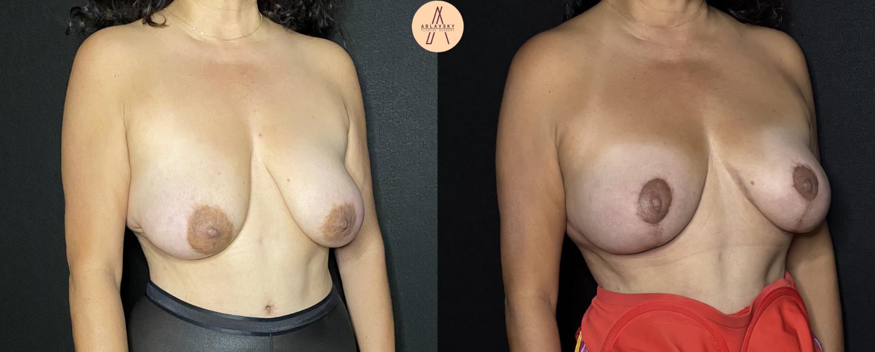Before & After Breast Lift Case 194 Right Oblique View in San Antonio, Texas