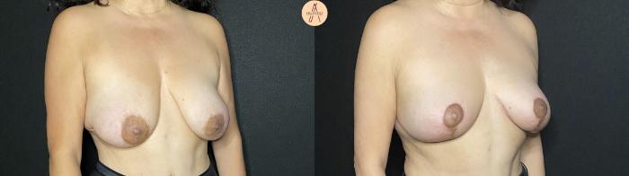 Before & After Breast Lift Case 194 Right Oblique View in San Antonio, Texas