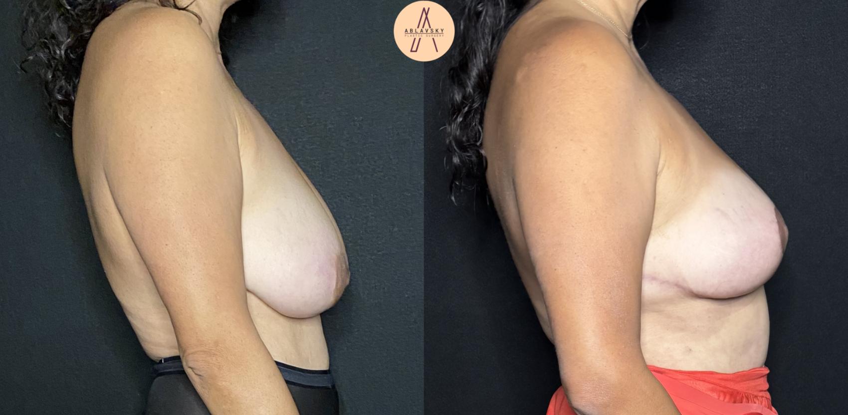 Before & After Breast Lift Case 194 Right Side View in San Antonio, Texas