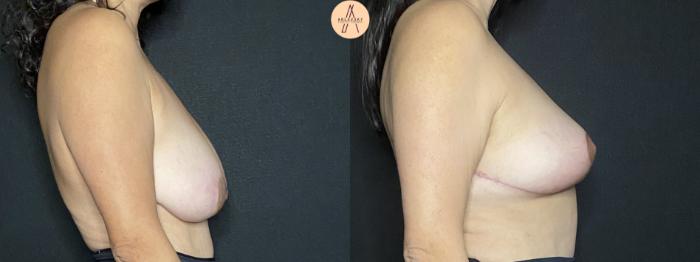 Before & After Breast Lift Case 194 Right Side View in San Antonio, Texas