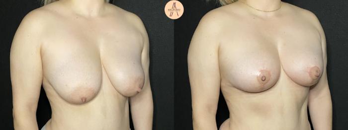 Before & After Breast Lift Case 200 Right Oblique View in San Antonio, Texas