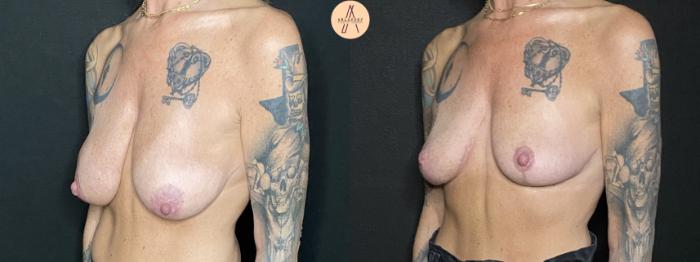 Before & After Breast Lift Case 203 Left Oblique View in San Antonio, Texas
