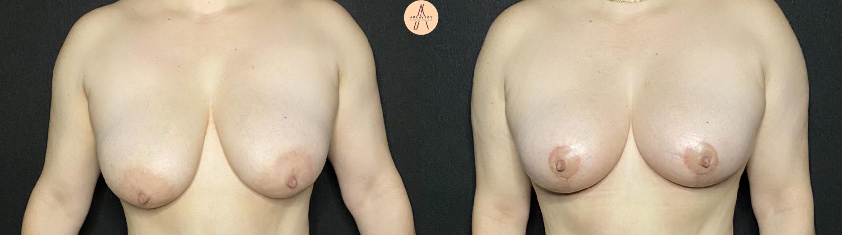 Before & After Breast Lift Case 228 Front View in San Antonio, Texas