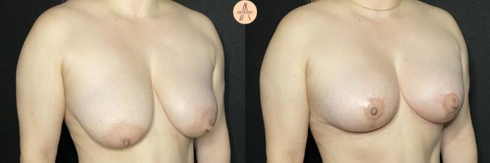 Before & After Breast Lift Case 228 Left Oblique View in San Antonio, Texas