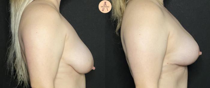 Before & After Breast Lift Case 228 Left Side View in San Antonio, Texas