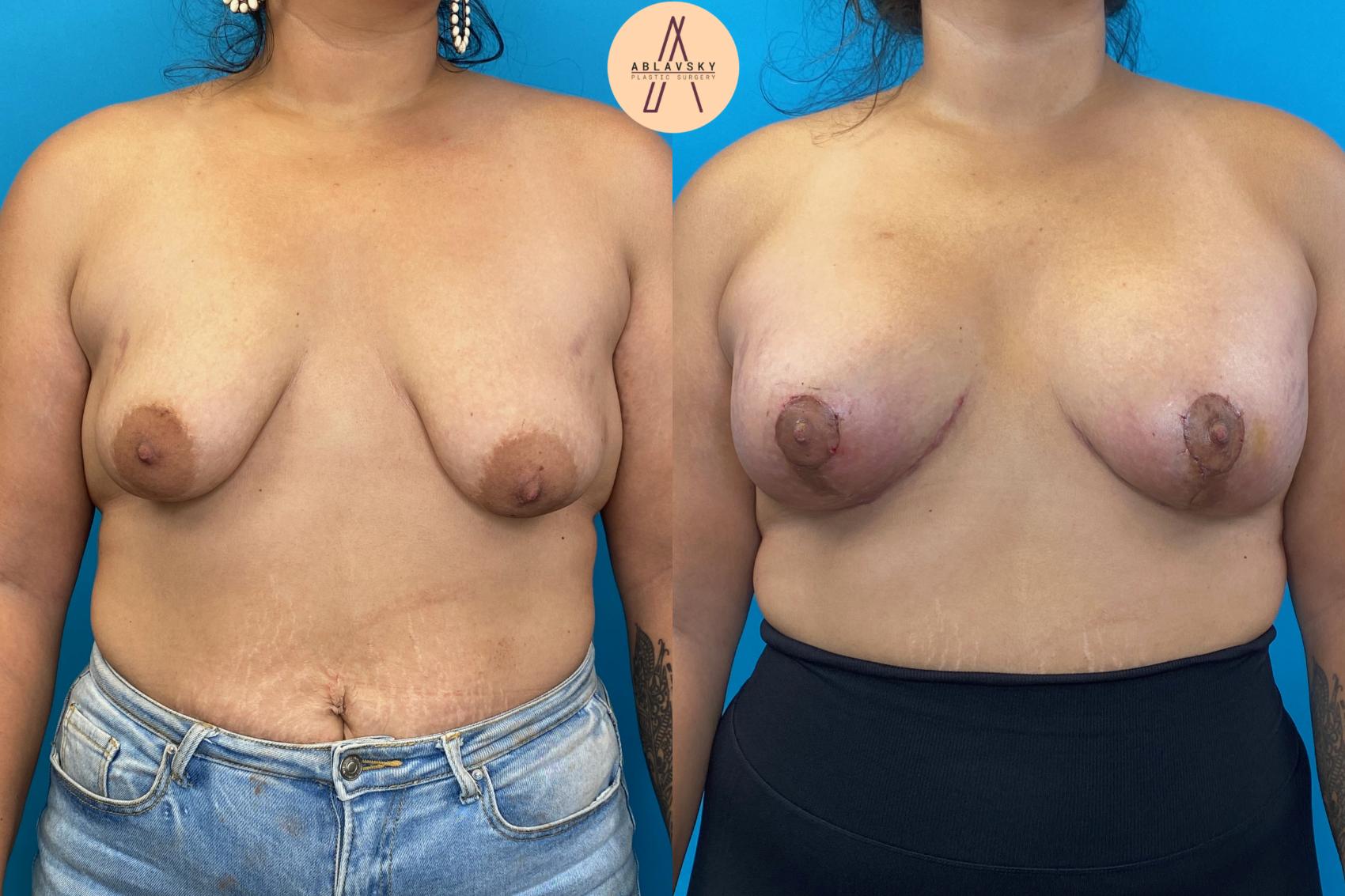 Combined breast lift (mastopexy) + augmentation, 475cc, Front view 