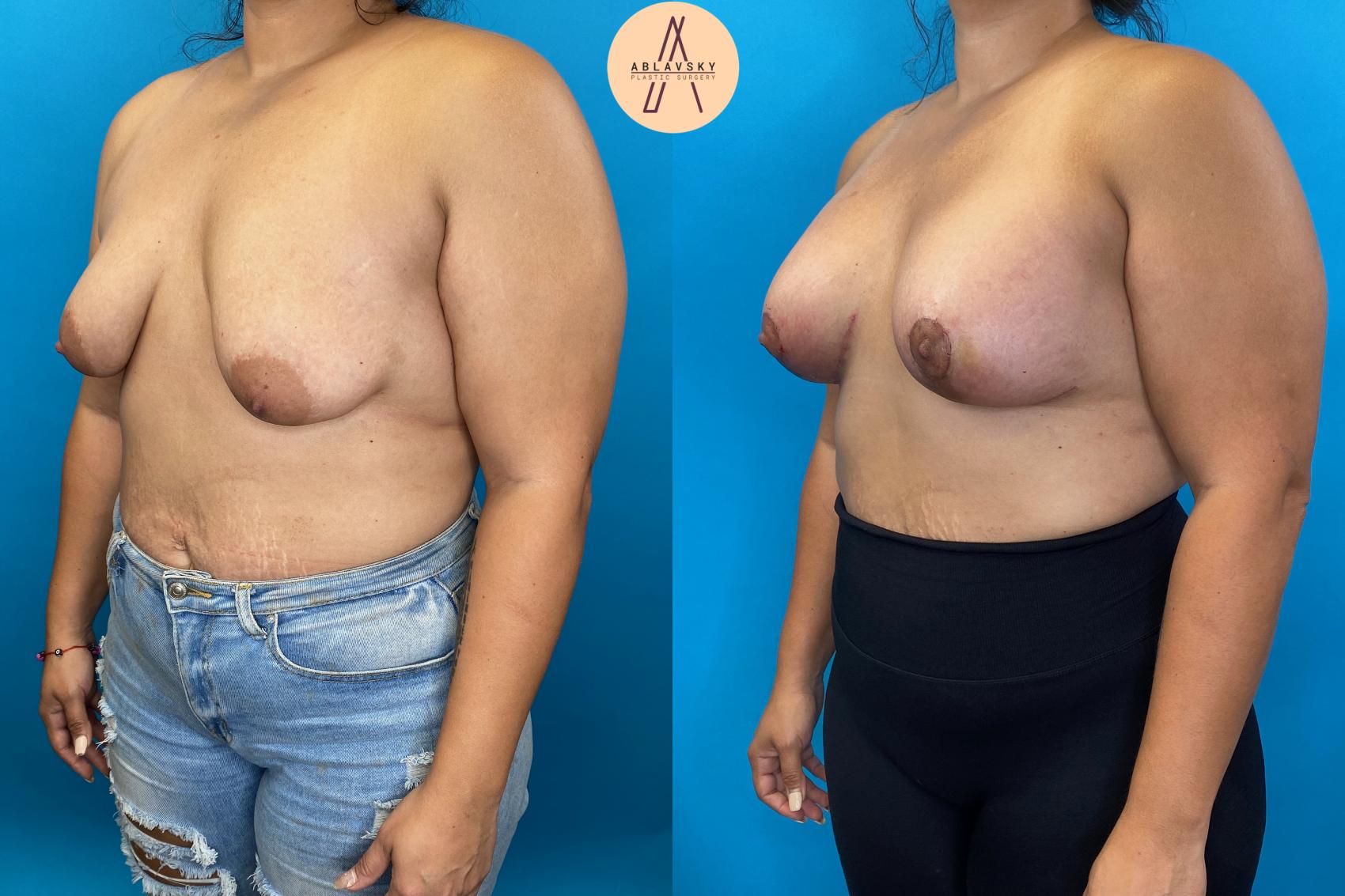 Before & After Breast Lift Case 23 Left Oblique View in San Antonio, Texas