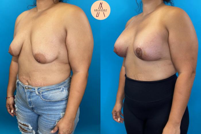 Before & After Breast Augmentation Case 23 Left Oblique View in San Antonio, Texas