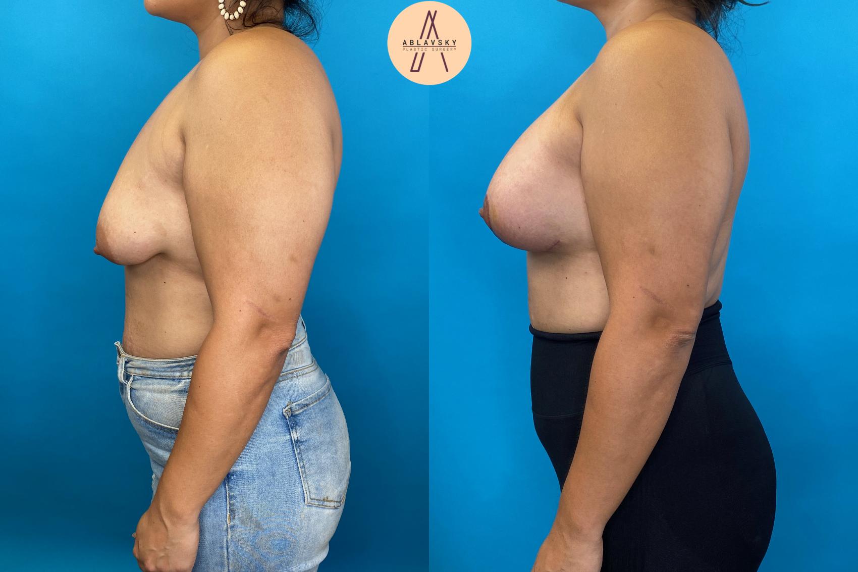 Before & After Breast Lift Case 23 Left Side View in San Antonio, Texas