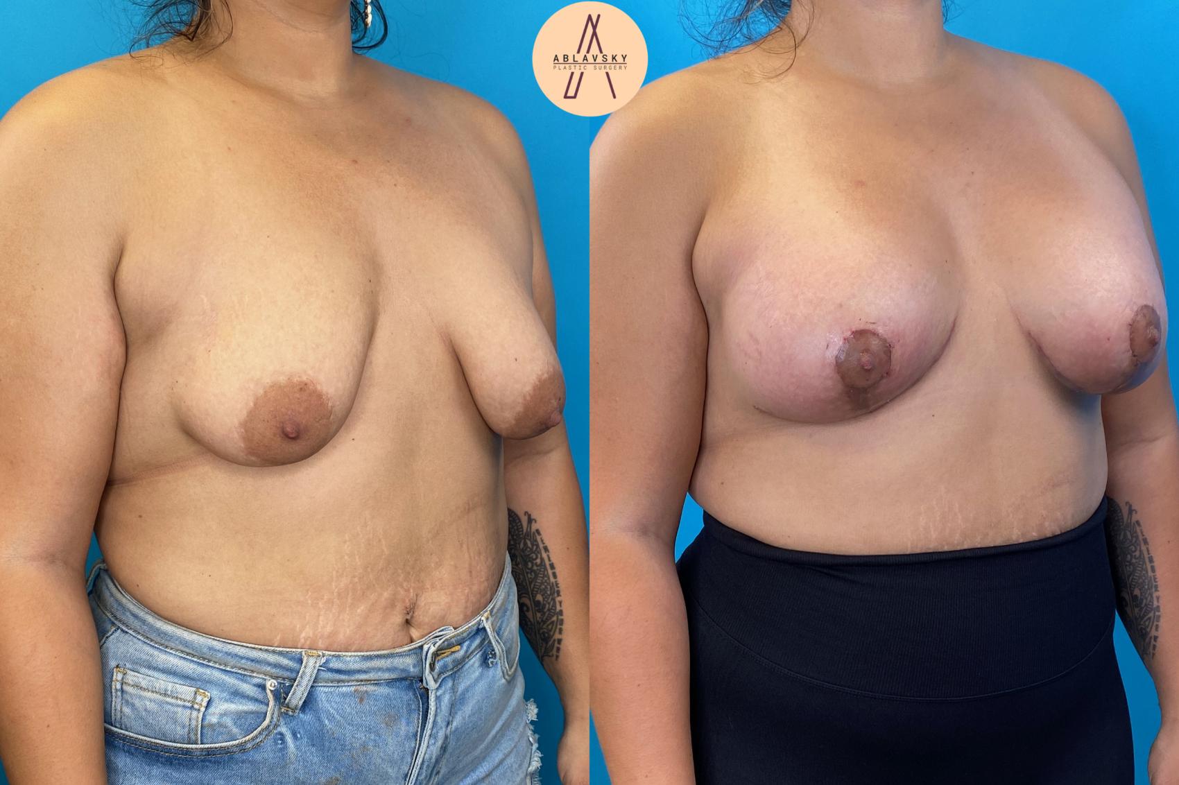 Before & After Breast Lift Case 23 Right Oblique View in San Antonio, Texas
