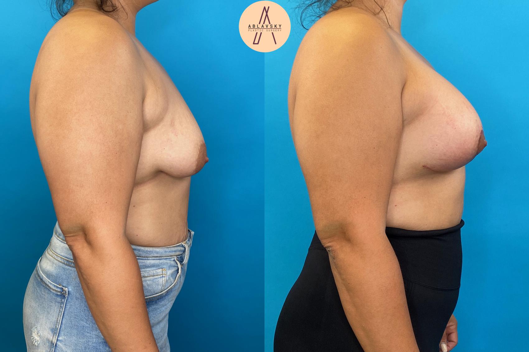 Breast lift (mastopexy) + augmentation. Right side view 