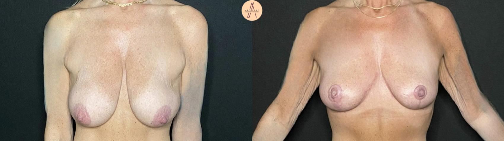 Before & After Breast Lift Case 237 Front View in San Antonio, Texas