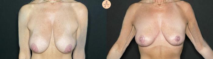 Before & After Breast Lift Case 237 Front View in San Antonio, Texas