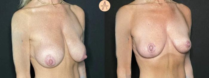 Before & After Breast Lift Case 237 Right Oblique View in San Antonio, Texas