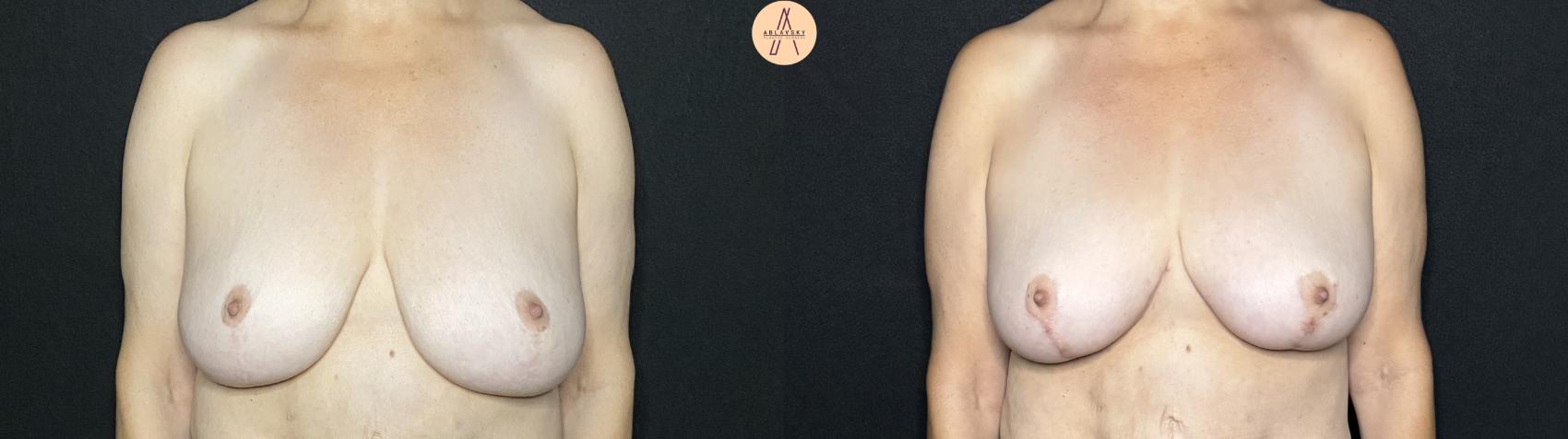 Before & After Breast Lift Case 268 Front View in San Antonio, Texas