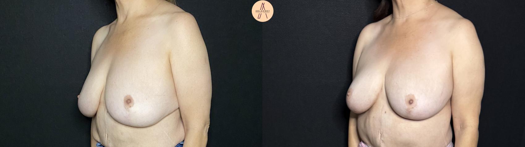 Before & After Breast Lift Case 268 Left Oblique View in San Antonio, Texas