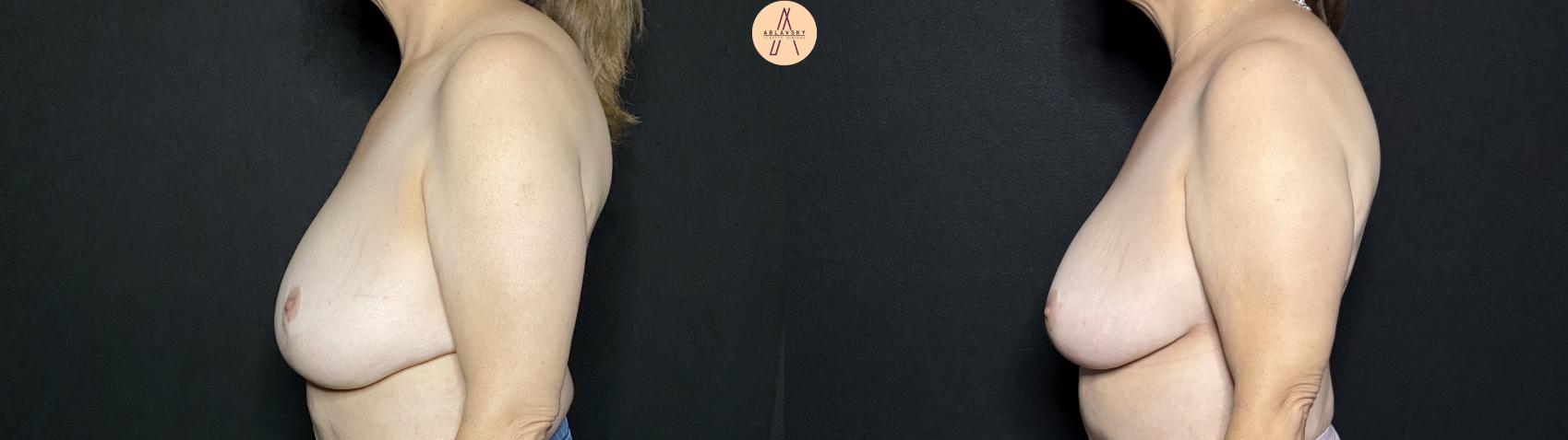Before & After Breast Lift Case 268 Left Side View in San Antonio, Texas